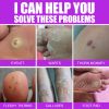 South Moon Remove Chicken Eye Lotion Extra Clear Remove Corns Skin Care Chicken Calluses Foot Pad Gram Warts